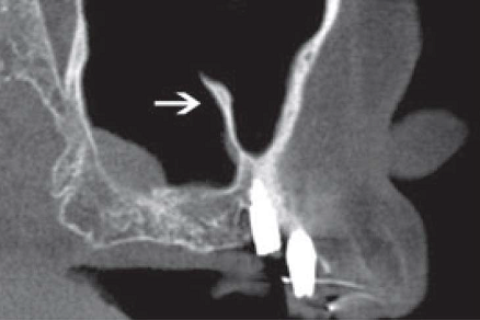 Figura 1. Septo sinusal (imagen tomada de Pelinsari et al.8).