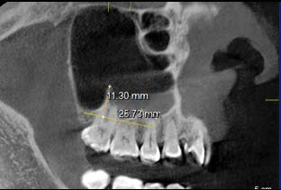 Figura 2. Medida de septo congénito (presencia desepto adyacente a pieza dentaria). (Imagen tomadade uno de los pacientes de este estudio).