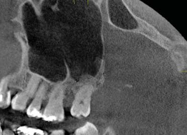 Figura 3. Otros septos. (Imagen tomada de uno de los pacientes de este estudio).