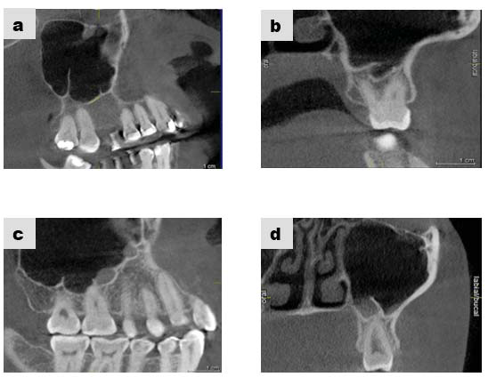 Figura 4. Septos congénitos (a,b,c,d). (Imagen tomada de uno de los pacientes de este estudio).