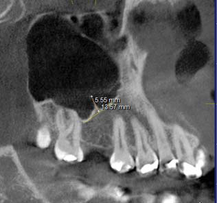 Figura 5. Medida de otros septos (presencia de septo adyacente a zona edéntula). (Imagen tomada de uno delos pacientes de este estudio).