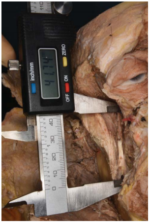 Figura 5. Medición de hemicara derecha.