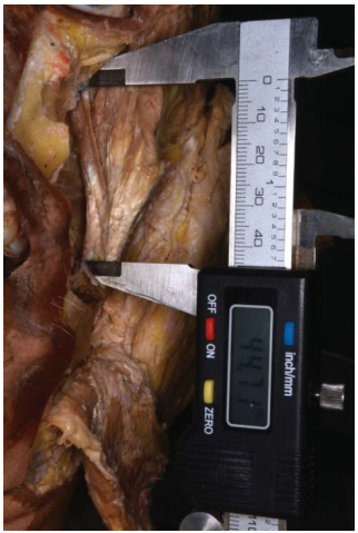 Figura 6. Medición de hemicara izquierda.