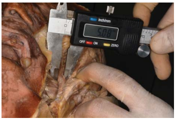Figura 7. Medición del ancho del músculo esfeno mandibular.