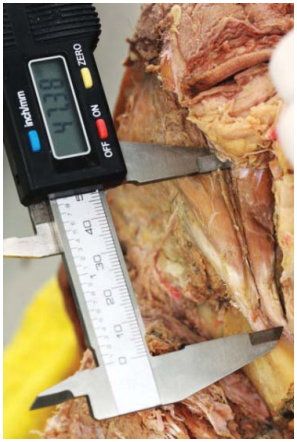 Figura 3. Inserción superior e inferior del músculo esfeno mandibular.