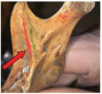 Figura 4. Inserción inferior del músculo esfeno mandibular.