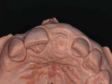 Figura 3. Gesso, aspecto inicial, vista oclusal.