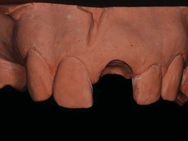 Figura 5. Gesso, área preparada, vista frontal.
