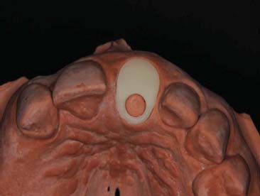 Figura 6. Tampão de resina confeccionado.