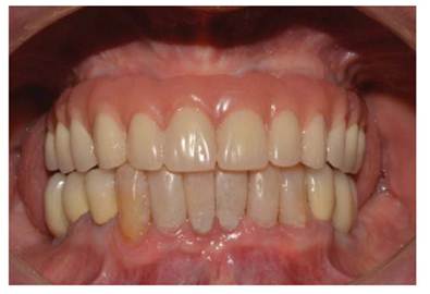 b coronas cementadas sobre implantes en Max. Inferior