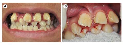 Fotografías clínicas intraorales. A, B: Vista frontal. Dientes SN entre piezas dentarias 1.1 y 1.3, 2.1 y 2.3. Erupción ectópica de piezas 1.1, 1.3, 2.1 y 2.3, mordida cruzada anterior y posterior del lado derecho.