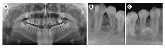 Radiografías. A: Panorámica. B: Periapical del Cuadrante III (3 dientes SN parapremolares). C: Periapical del Cuadrante IV (2 dientes SN parapremolares).