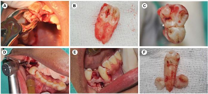 A: Prensamiento con fórceps del diente SN fusionado. B: Vista lateral de diente SN fusionado. C: Vista de la corona de diente SN fusionado. D: Decolado mucoperióstico y osteotomía (post exodoncia de pieza dentaria 4.4). E: Cavidad ósea de diente SN. F: Dientes SN parapremolares y pieza dentaria 4.4.