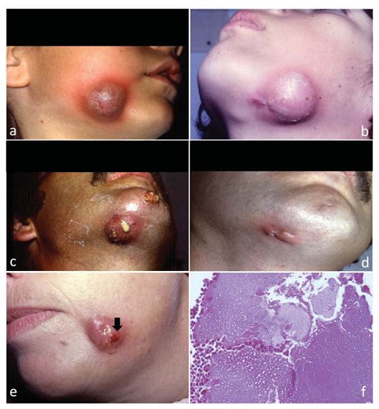 Cervicofacial actinomycosis. Solid mass in mandibular region in a child (a) and in an adult patient (b); the nodule becomes fistulated, with draining pus (c), which can lead to scarring after treatment (d); within the material discharged through the fistulae, it is possible to see the sulfur granules (e, arrow) corresponding to the Actinomyces colonies (f, HE, 400X).