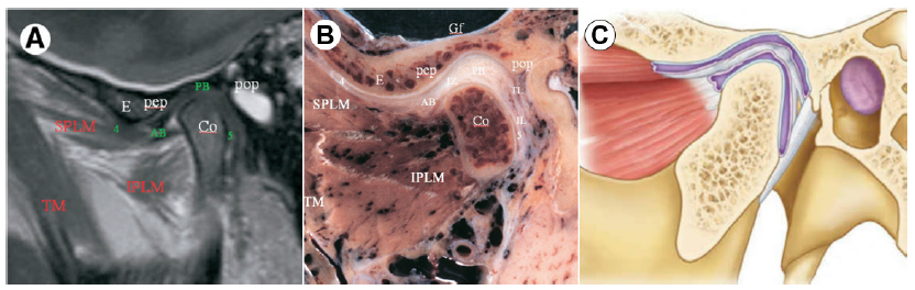 Figura 5. Cortes parasagital medial a nivel de inserción del pterigoideo externo.