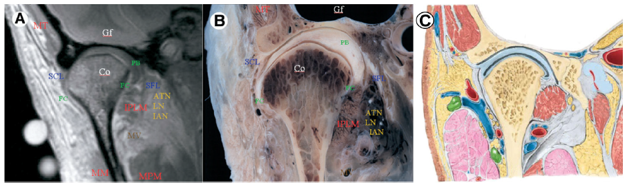 Figura 6. Cortes a nivel coronal estricto del cóndilo mandibular. 