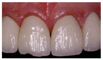Figura 3. Fractura de cerámica de recubrimiento connúcleo de Y-TZP (anterior) (5).