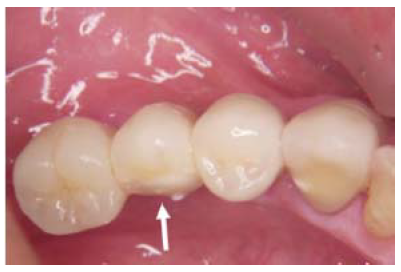Figura 4. Fractura de cerámica de recubrimiento con núcleo de Y-TZP (posterior)(6).