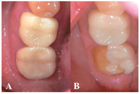 Figura 6. Restauración de zirconia monolítica fracturada.(A) Restauración cementada y (B) Control a los 38 meses de cementada (2).
