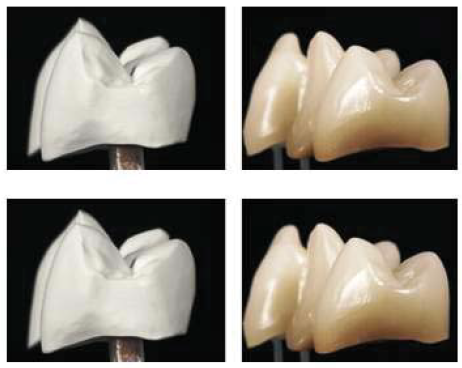 Figura 7. Coronas monolíticas de Y-TZP antes desinterizado (izquierda) y después del sinterizado y maquillado (derecha) (7).