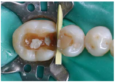 Figura 3. Aplicacion de sistema adhesivo posterior a la aplicación del protector pulpar