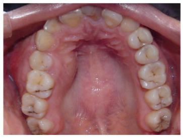 Figura 1. Tumor que expande la tabla ósea vestibular y palatina a nivel pieza 15 y 16. Mucosa oral intacta