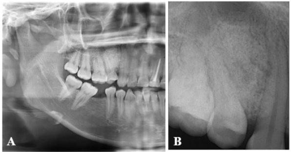 Figura 2. 2a) Radiografía panorámica: muestra en mesial de pieza 15 radiopacidad en forma de pera invertida que se extiende desde la cresta ósea alveolar hasta el límite con el piso del seno maxilar. 2b) La radiografía periapical muestra la misma lesión radiopaca con aspecto granular rodeada parcialmente por una línea radiolúcida