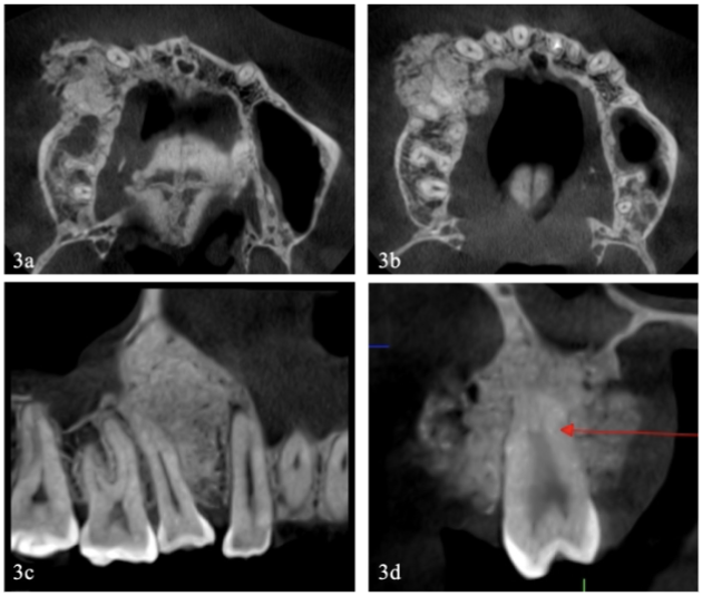 Figura 3. TCHC 3a) C. axial a nivel apical de dientes: masa ubicada entre 13 y 16, forma redonda, hiperdensa con focos isodensos, protruye hacia vestibular. 3b) C. axial a nivel medio de las raíces: masa hiperdensa heterogénea de bordes regulares que protruía hacia vestibular y palatino. 3c) C. sagital: masa hiperdensa, forma de pera invertida, en mesial de 15, separada de la cortical del piso del seno por una línea isodensa. 3d) C. transaxial a nivel de 15: masa hiperdensa en vestibular y palatino, el borde vestibular es marcadamente irregular. Leve reabsorción apical (flecha).