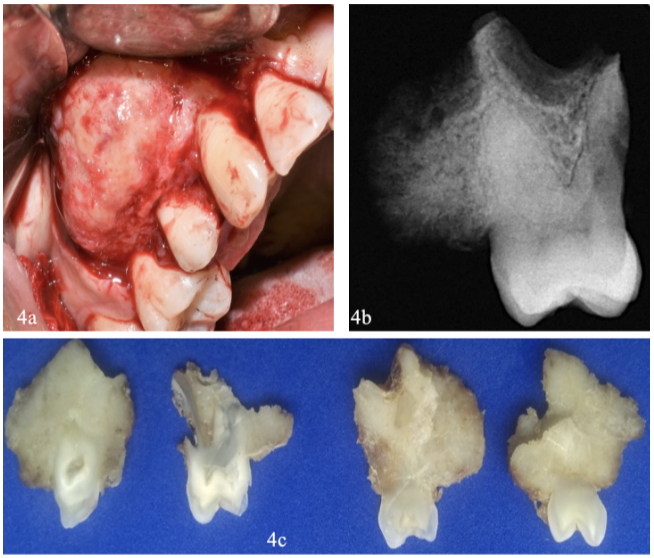 Figura 4. 4a) Imagen transoperatoria: expansión del hueso cortical vestibular en piezas 13,15 16. 4b) Radiografía de la pieza quirúrgica; masa radiopaca adherida a 15 que exhibe proyecciones filamentosas dispuestas radialmente. 4c) Cortes de la pieza quirúrgica a diferentes niveles que muestran una masa grisácea adherida en vestibular y palatino de 15.