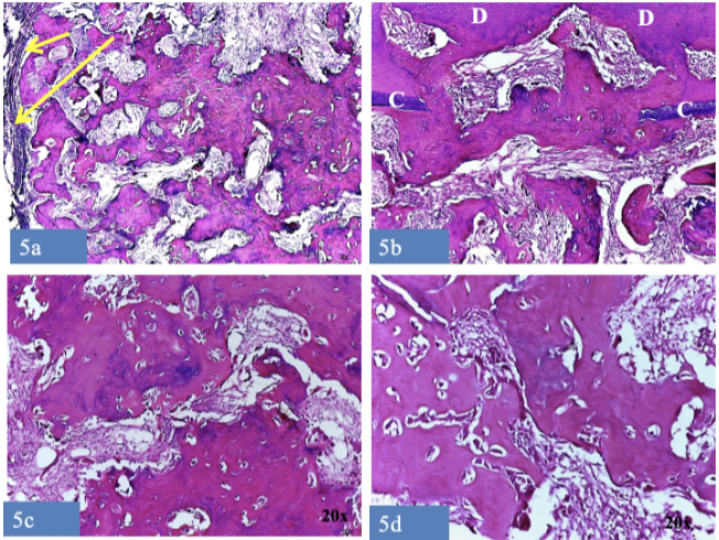 Figura 5. Histopatología: 5a) Cápsula de tejidos conectivo fibroso (flechas) que se continua con el estroma del tumor 5b) Zona de reabsorción radicular por reemplazo: el tumor atraviesa el cemento del diente (C) llegando hasta la dentina (D) la cual está reabsorbida y unida al tumor. 5c) Trabéculas gruesas de cemento con algunas líneas de reversión y estroma de tejido conectivo laxo vascularizado conteniendo cementoblastos y cementoclastos. 5d) En el estroma se distinguen ce-mentoblastos grandes adosados a las trabéculas de cemento.