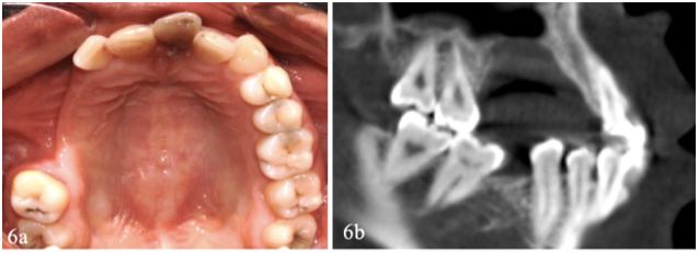 Figura 6. Control clínico y radiográfico después de 8 meses del tratamiento quirúrgico: 6a) Muestra la mucosa con características normales, 6b) Las paredes del hueso que limita al defecto creado por el procedimiento quirúrgico lucen normales.