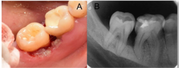 Figure 2. A: Area of ulceration and necrosis located in the gingiva and alveolar mucosa associated with tooth 46.  B: Periapical radiography showing horizontal bone loss located through the mesial area of tooth 46 and the distal area of tooth 45