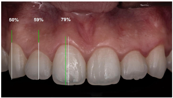 Figura 1. Porcentaje de ubicación del cenit gingival. El incisivo central 72% en los incisivos laterales el 59,2% el eje longitudinal del diente y los caninos 50,5%