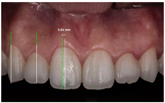 Figura 2: Distancia del cénit gingival al eje longitudinal de piezas dentarias del sector antero superior. El Incisivo central superior tenía un cenit con un promedio 0.54 mm de desviación hacia distal del eje axial.