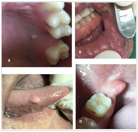 Figura 1. Ejemplos de localizaci�n de la lesi�n hiperplasia fibrosa focal:A. Mucosa de paladar duro, B. Mucosa de labio inferior, C. Superficie dorsal de lengua,D. Reborde alveolar, zona retromolar.