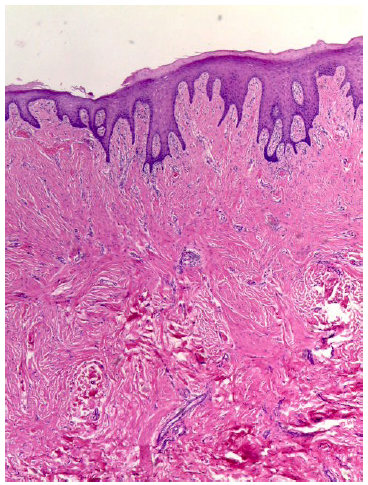 Figura 2. Fotograf�a de estudio histopatol�gico de la lesi�n &ldquo;hiperplasia fibrosa focal&rdquo;. 20X, tinci�n hematoxilina-eosina, donde se observa lesi�n recubierta por epitelio escamoso hiperpl�sico, sin atipia ni cambios displ�sicos con presencia de incrementos de col�geno con �reas de hialinizaci�n en la l�mina propia. 