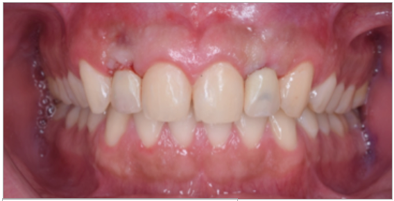 Figura 9. Instalación del provisional a las 2 semanas.