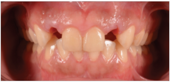 Figura 10. Instalación del provisional a las 4 semanas.