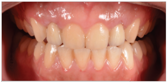 Figura 11. Instalación final con coronas metal cerámicas cementadas.