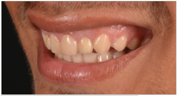 Figura 12. Instalación final con coronas metal cerámicas cementadas.