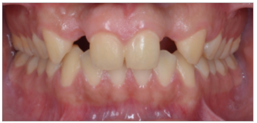 Figura 1. Examen intraoral presentó agenesia de las piezas 12 y 22.