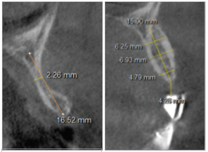 Figura 3. Análisis tomográfico