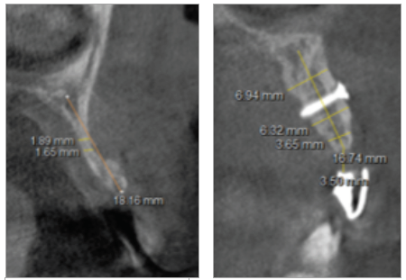 Figura 4. Análisis tomográfico