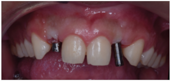Figura 5. Implante de provisionales.