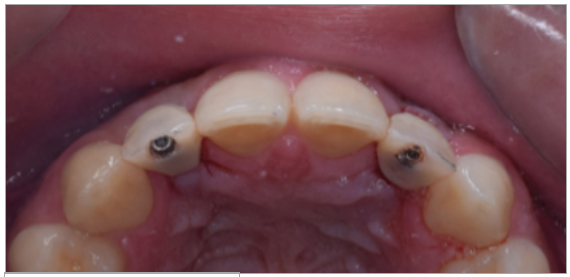 Figura 6. Implante de provisionales.