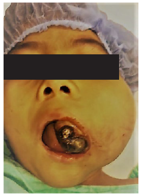 Figura 1. Femenino 8 aos de edad con aumento de volumen que involucra va area.