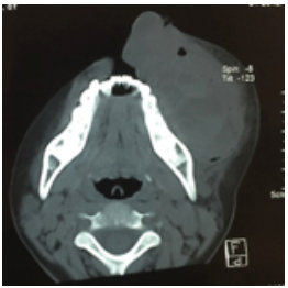Figura 2. Corte axial de tomografa computarizada contrastada de macizo facial, donde se observa extensin de lesin central de clulas gigantes a tejidos blandos.