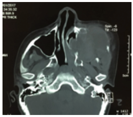 Figura 3. Corte axial de tomografa computarizada contrastada de macizo facial, considerndose involucro de la lesin a estructuras importantes como seno maxilar, fosas nasales y fosa cigomtica izquierdas.