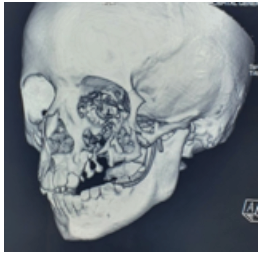 Figura 4. Reconstruccin 3D de tac simple de macizo facial, posterior a intervencin quirrgica, donde se observa derivacin de conducto parotdeo izquierdo.