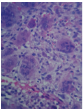 Figura 5. Cortes histolgicos muestran neoplasia conformada en su mayora por clulas gigantes multinucleadas, de tipo osteoclasto, nmero de ncleos de 10 a 30 aproximadamente. Con atipia de bajo grado y estroma de tejido fibroconectivo.